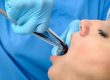 Dentist extracting a tooth