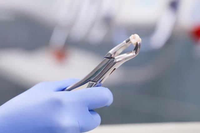 Tooth Extraction vs Root Canal Treatment
