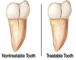 cracked-teeth Image of treatable cracked tooth