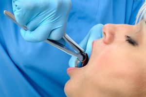 Choosing Between Tooth extraction and Root Canal