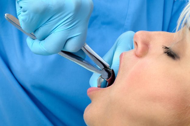 Choosing Between Tooth extraction and Root Canal Choosing Between Tooth extraction and Root Canal