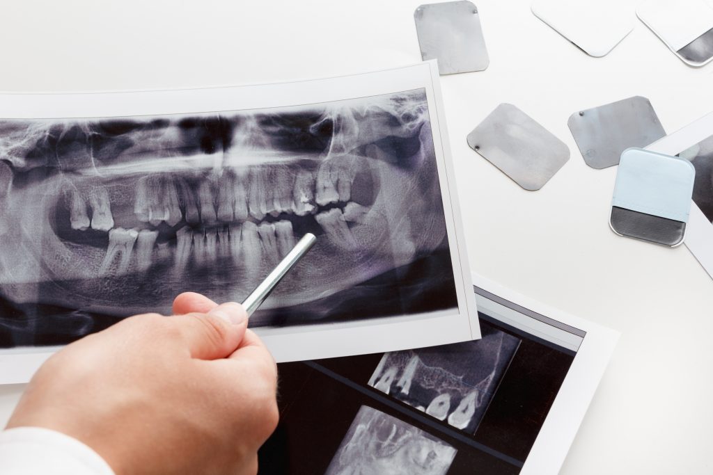 What Is Endodontic Care and What Treatments Does It Include?