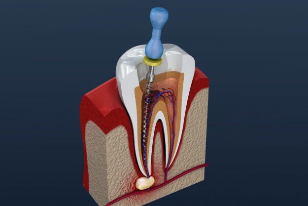 root-canal-illustration Root Canal Treatment Illustration