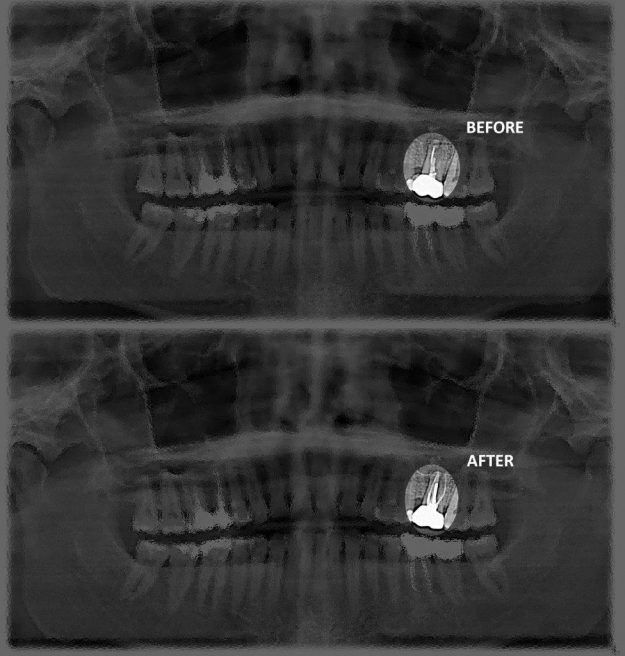 Dr-Sameti-Root-Canal-Retreatment-Before-After Endodontic retreatment and Save a tooth